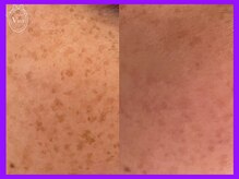 ヴィオール 名古屋栄店(VIOR)/光フェイシャル