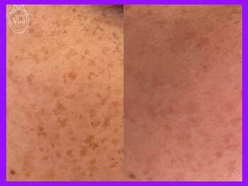 ヴィオール 名古屋栄店(VIOR)/光フェイシャル