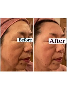 トータルビューティーサロン 凛/光フォトでエイジングケア