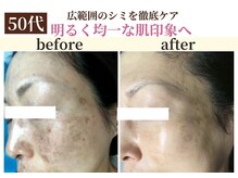 パールホワイトニング/ハーブピーリングでトラブル改善