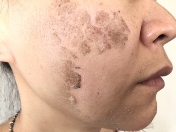 ラマジ(Lamazi)/ハーブピーリング