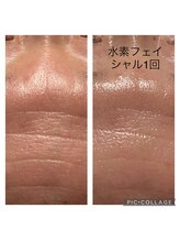 みや美/水素フェイシャル1回施術