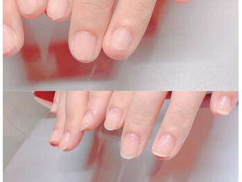 アモールネイル(amor nail)/深爪にお悩みの方はご相談下さい