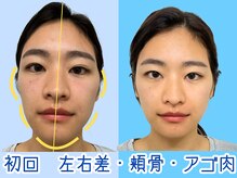 ナチュラルビューティーフェイス 横浜(NBF)/26才/左右差/エラ/頬骨/横浜小顔