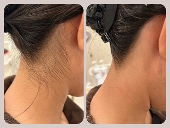 ドクターリバース(Dr.Reverse)/【うなじ脱毛】ワックス脱毛