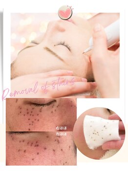 ココロ(COCORO)の写真/【シミケアに最適な季節♪2ミリ10か所¥3,300~】濃い~薄いシミ・目の周りのシミケアまでお任せ下さい◎