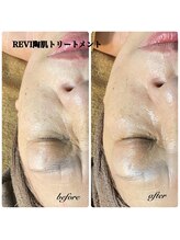 ベルフルール 東札幌店/REVI  陶肌フェイシャル
