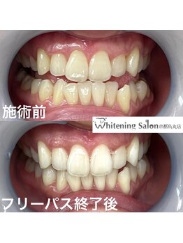 ホワイトニングサロン 京都烏丸店/ホワイトニング施術例