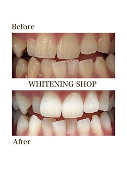 ホワイトニングショップ 豊橋店/Before&After美白ホワイトニング