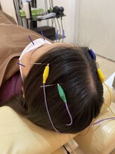 そら鍼灸接骨院 イオンモールつくば店/ハリ施術で頭痛改善　頭皮ケア