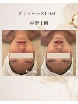 フォルディオ(FORDIO)/プラピール×LDM