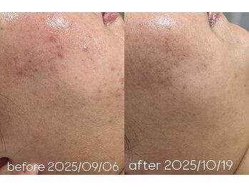 アンリミット 下北沢店(Une limit)/【本気の肌質改善！！】