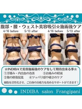 フランジパニ/【インディバ☆美容吸引後ケア】