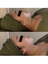 シーアイエステティック 船橋駅前店(c.iエステティック)/レモンボトル★ビフォーアフター