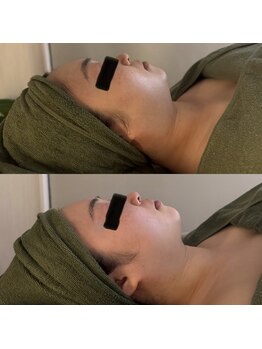 シーアイエステティック 船橋駅前店(c.iエステティック)/レモンボトル★ビフォーアフター