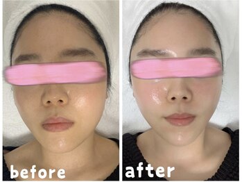 エクスクラメーションマーク(!!!)/水光ジェット