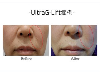 アンドエピ(&epi)/韓国痩身フェイシャル症例写真６