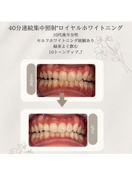 プラスビーセルフ(+b self)/ホワイトニングビフォーアフター