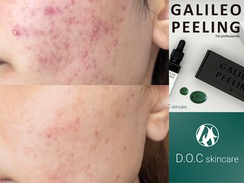 ビューティーサロン グラット(beauty Salon glatt)/ガリレオピーリング(2)