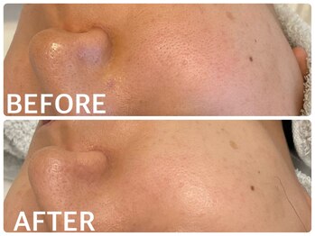 ハーブピーリング 恵比寿/乾燥/毛穴/角質/角栓/くすみ