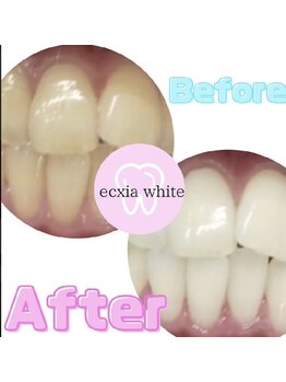 エクシアホワイトニング 新白河店/ホワイトニングビフォーアフター