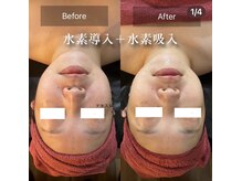 ミルティー(Myrtille)/水素導入・吸入後の効果