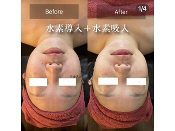 ミルティー(Myrtille)/水素導入・吸入後の効果