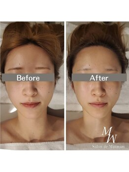 ミピマムマール(Mipimam Maaru)/お客様before→after