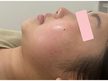ピュール(pure)の写真/《韓国発★天然成分だけのオーガニック製剤》レモンボトル&エステダーマで美肌角質ケア！