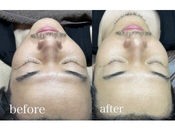 ハーク(haac)/シワ改善ハーブピーリング