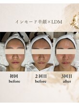 フォルディオ(FORDIO)/インモード半顔×LDM