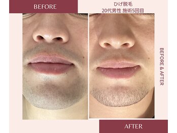 ウェルネス ステーション リンク(Wellness Station Link)/ヒゲ脱毛 5回施術後