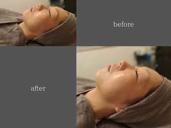 テリー(Terry)/肌質改善トリートメント