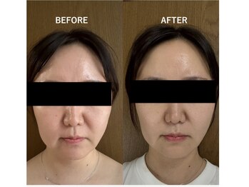 サロン リノ(salon rino)/【韓国小顔】メシダ脂肪分解