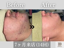ビューティーアンドボディメイクBB シャオ西尾店/無精髭がなくなり清潔感UP！