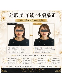 エモシオン トウキョウ(EMOTION TOKYO)/造形美容鍼×小顔矯正