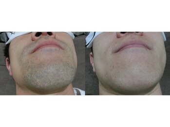 ラグジー 本八幡店(LUXY)/コンプレックスだった青髭も解消