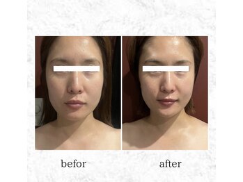 ビューティーマックス エースタジオ(Beauty MAX Astudio)/小顔＋リフトアップ！！