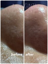 アンヴィオ ギンザ(Anvio Ginza)/毛穴吸引BeforeAfter