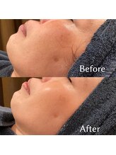 クレアトゥール ラポシュ(createur LA POCHE)/スポンジラハーブピーリング