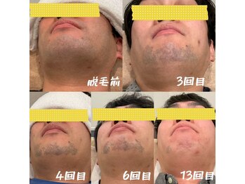 テトテ(tetote)/ヒゲ脱毛