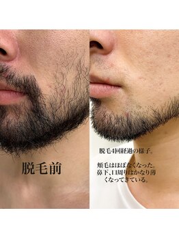 ヴァイオス 八王子(VIOS)/【デザイン】デザイン髭も可能！