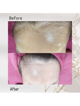 アンベリール(Embellir)/デザイン光脱毛で垢抜け♪