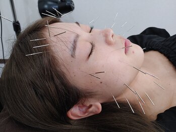 ケヤキ(KEYAKI)/お顔に使用する鍼は40本！！