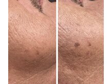 ラヴィエール(Laviere)/シミ緩和