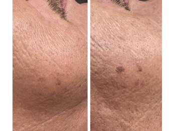 ラヴィエール(Laviere)/シミ緩和