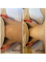 アルカディア(Arcadia)/うなじ脱毛/ビフォーアフター