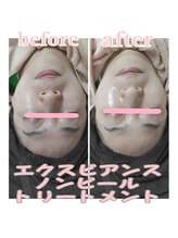 ピュルテ/水光ピールで韓国肌の艶肌へ！