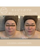 リリアーナ アサヒカワ(LILIANA ASAHIKAWA)/小顔キャビテーション