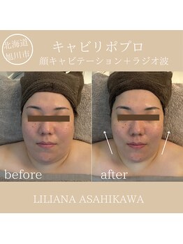 リリアーナ アサヒカワ(LILIANA ASAHIKAWA)/小顔キャビテーション